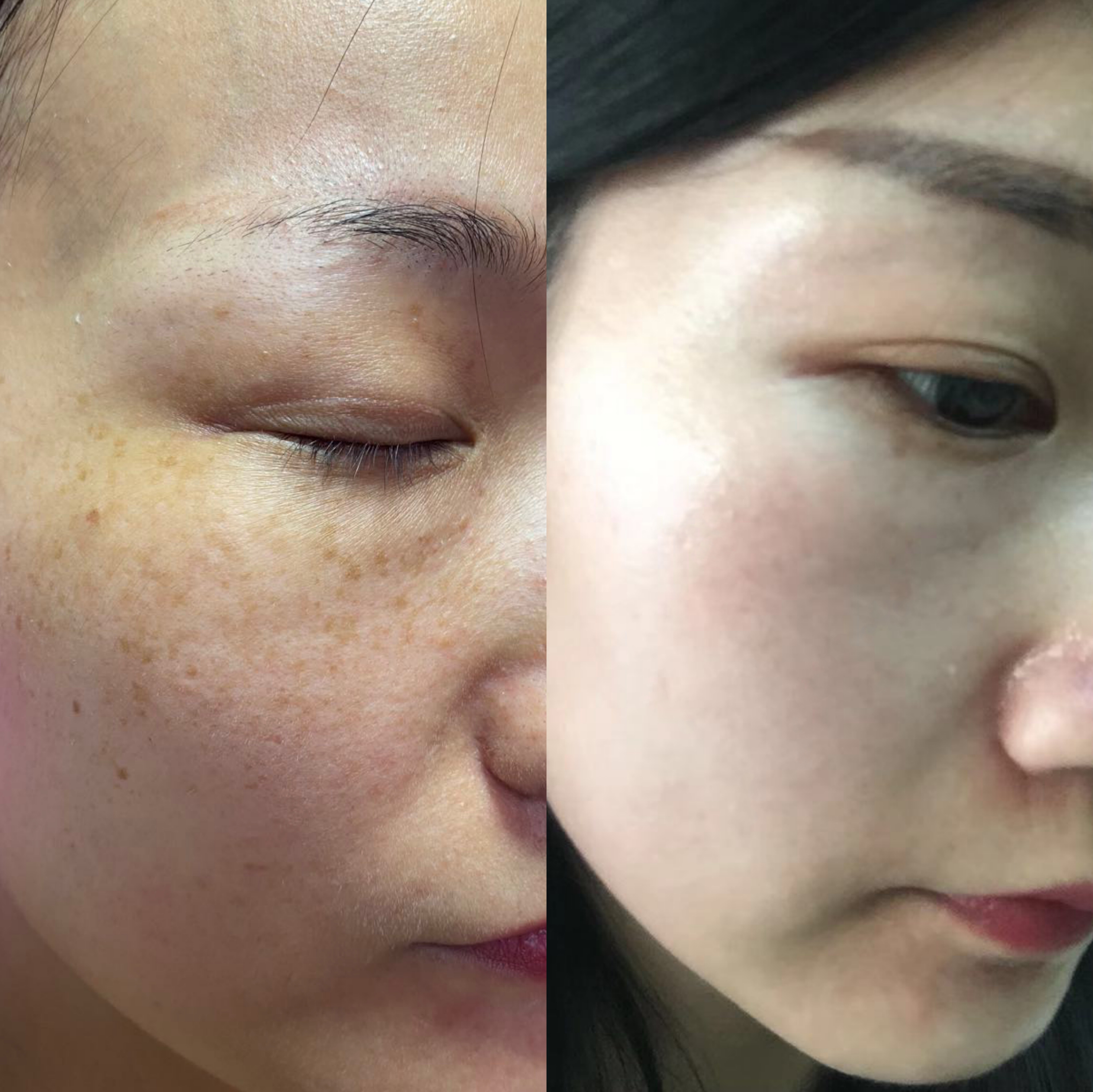 只对色素颗粒发挥作用,皮肤的表皮基本没有损伤,因此也不会在皮肤上留